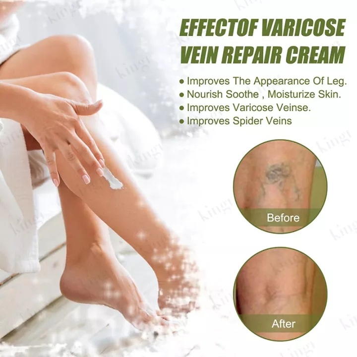 Krim Varises EELHOE | Krim Efektif untuk Varises di Kaki