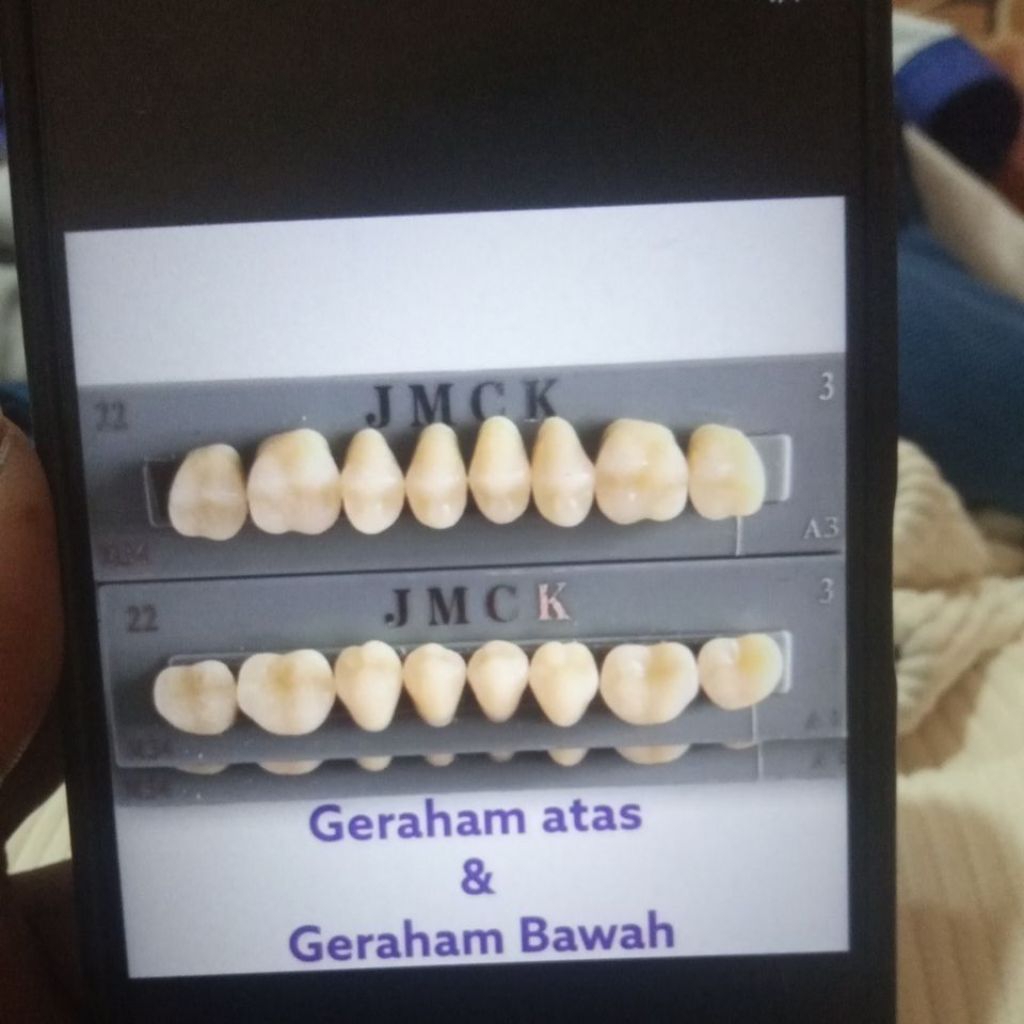 GIGI GRAHAM GIGI PALSU GRAHAM ATAS DAN GRAHAM BAWAH