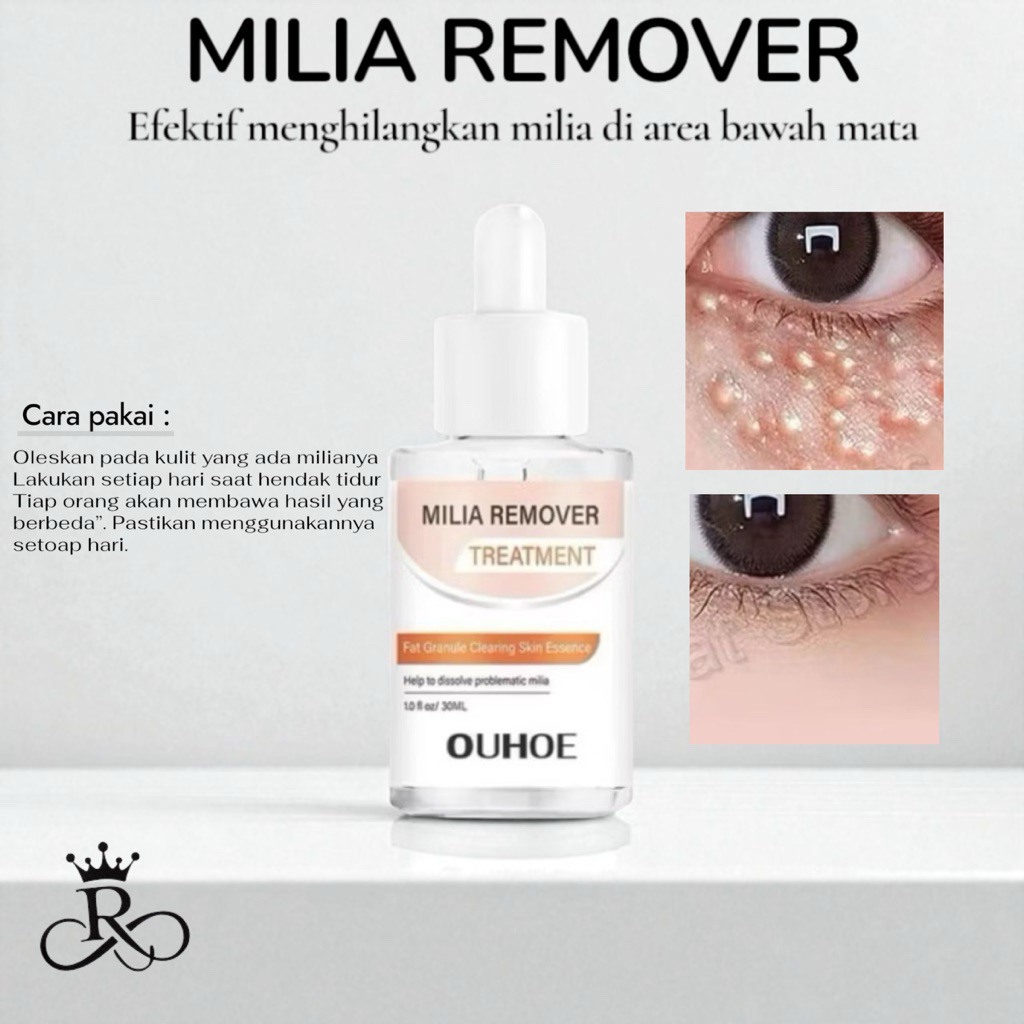 Milia Remover Serum Penghilang Perontok Milia Bintik Putih Mata Ouhoe Milia Remover Treatment Oil-Fr