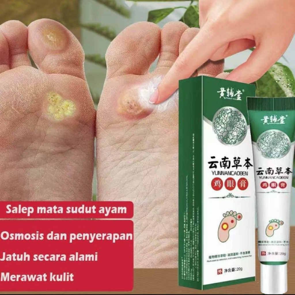 YUNANNCADEN obat mata ikan Obat Kutil Kapalan Mata Ikan Kaki 20g Kaki Ampuh Plester Penghilang Kutil