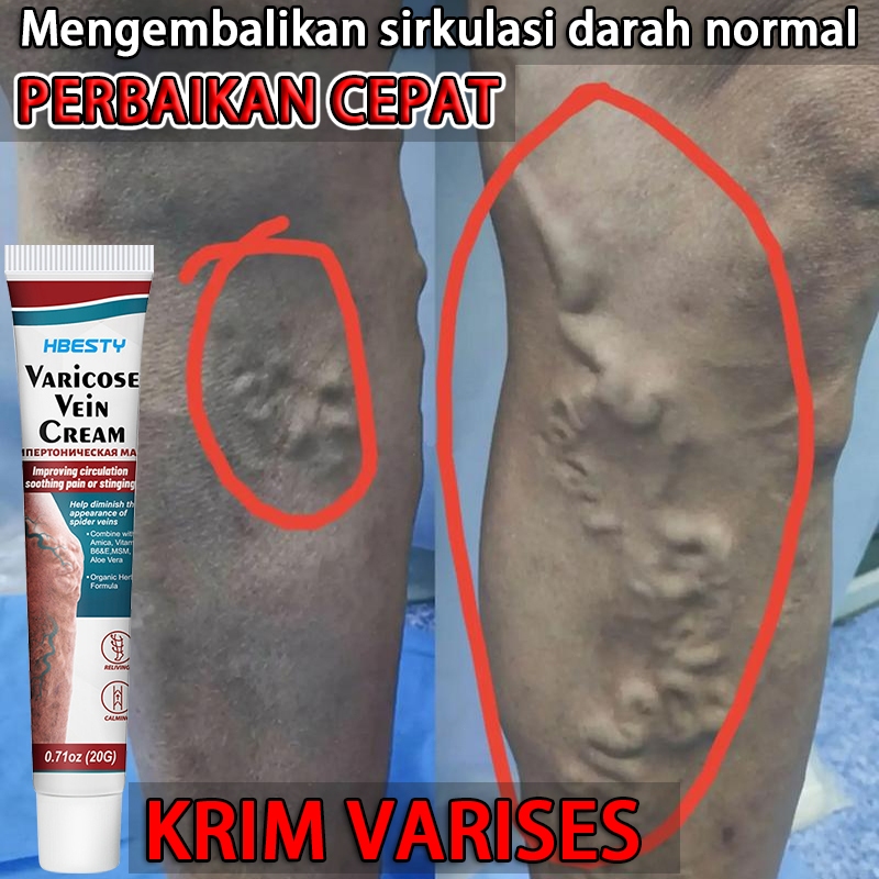 Krim Varises 20g Krim Pereda Varises Menghilangkan Varises Pereda Nyeri Varises dan Spider Veins Nye