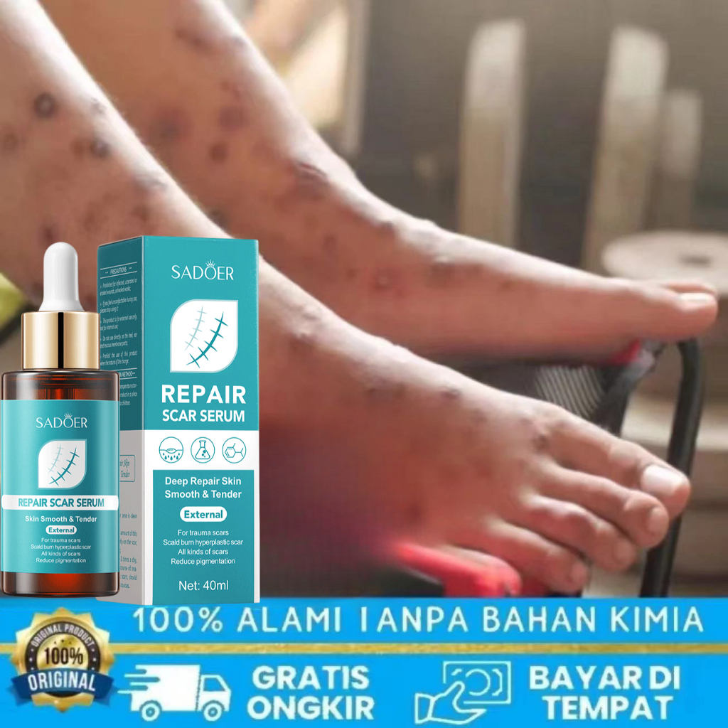 Serum Perbaikan Bekas Luka SADOER 40ml | Serum Perbaikan Bekas Luka | Keloid dan Stretch Mark