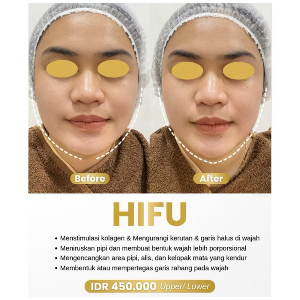 Hifu treatment (up and low)