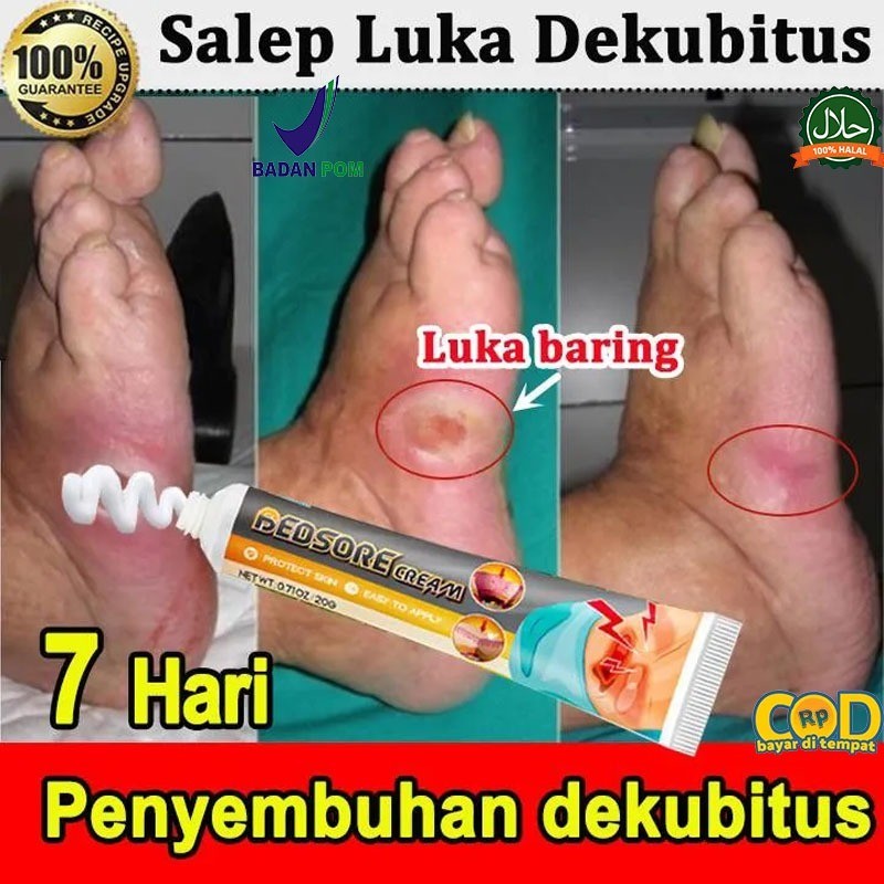 Krim Luka baring/Penyembuhan luka/Luka diabetes/ Krim dekubitus/Mengobati dekubitus 20g