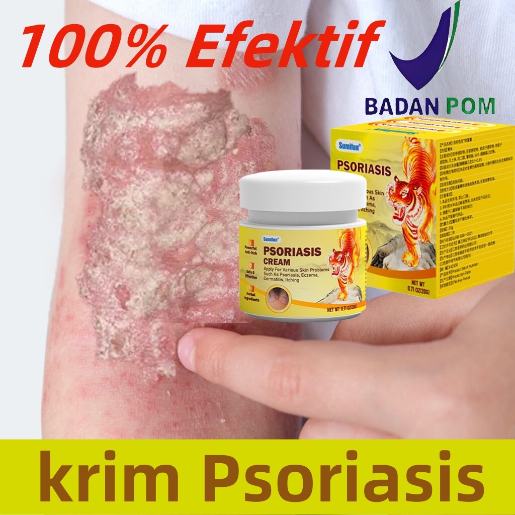 Salep gatal paling ampuh Psoriasis Salep psoriasis Obat kurap Obat kurap paling ampuh Salep gatal pa