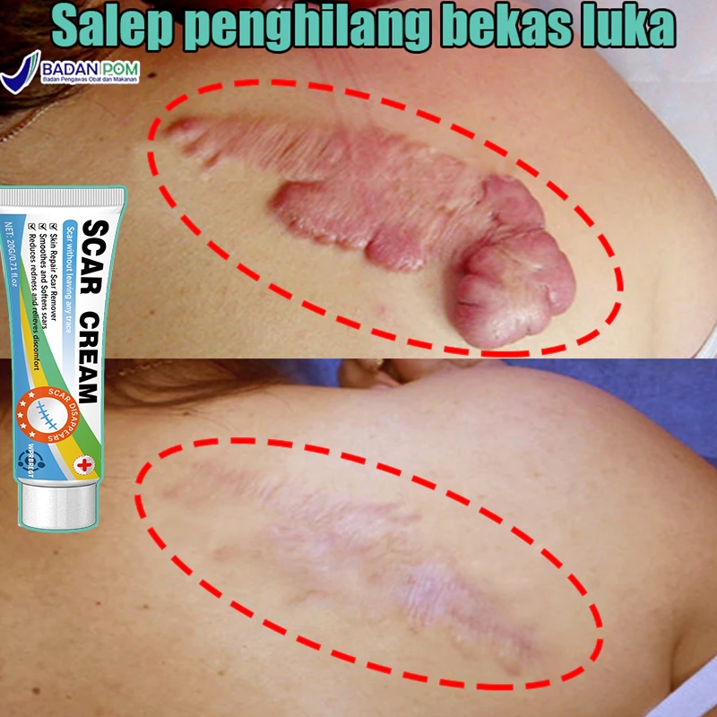 Krim penghilang bekas luka cepat, penghilang keloid, penghilang bekas luka hitam, bekas luka operasi