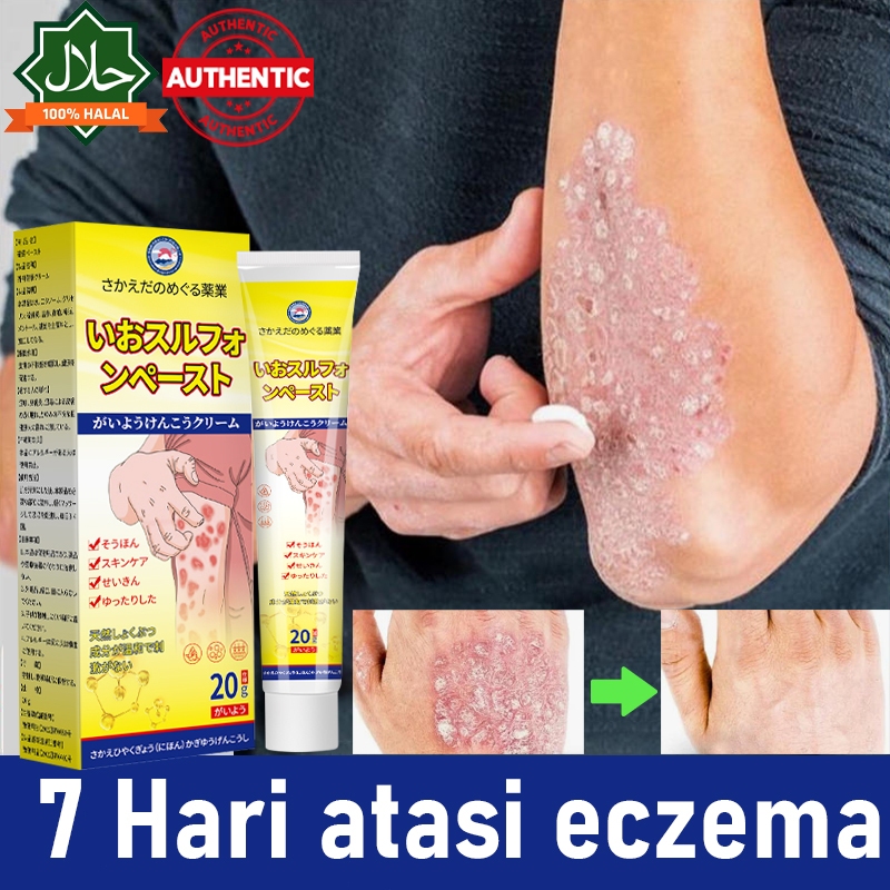 Krim eksim  cocok untuk Dermatitis gejala psoriasis  Infeksi jamur,Gatal akibat alergi jerawatselang