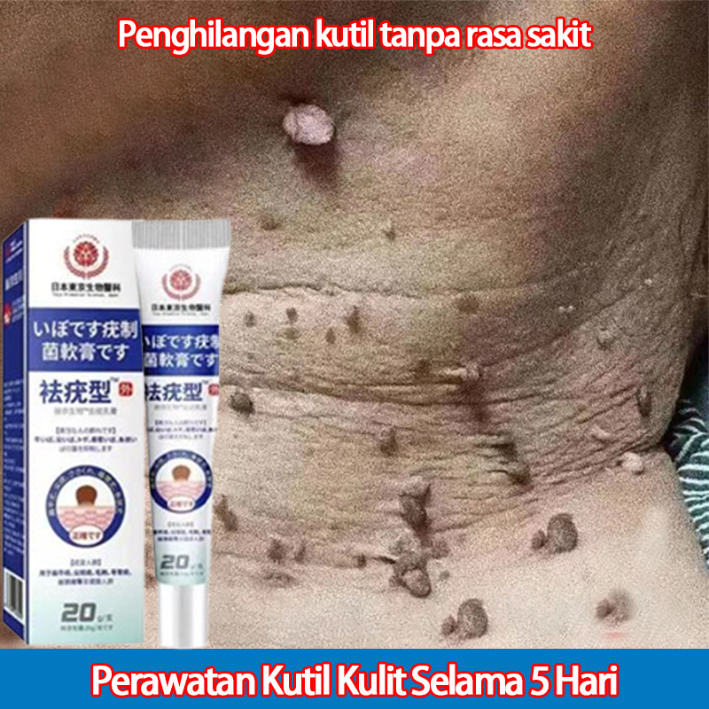 Obat Kutil Penghilang Kutil Di Leher Salep Kutil Paling Ampuh Penghilang Kutil Dan Tahi Lalat Salep 