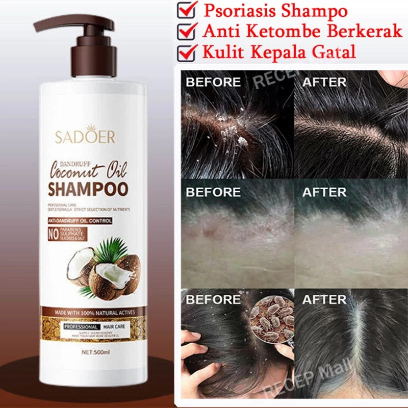 Shampo anti ketombe Penghilang Ketombe Berkerak Dan Gatal obat ketombe kerak kulit kepala obat ketom