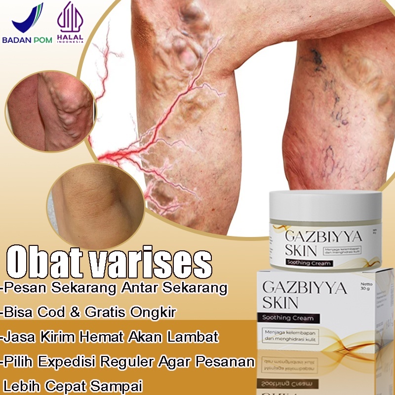 Obat varises Obat varises kaki Salep varises paling ampuh obat varikokel 30g obat varises original o