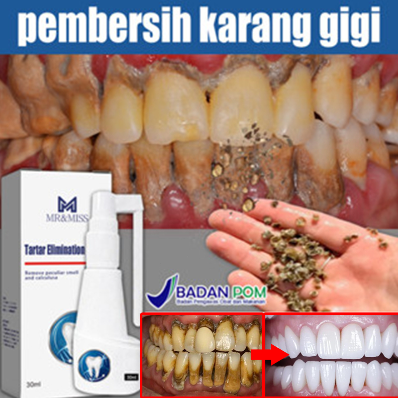 Odol pemutih gigi dan karang gigi Pembersih karang gigi berkerak Perontok karang gigi paling ampuh 3