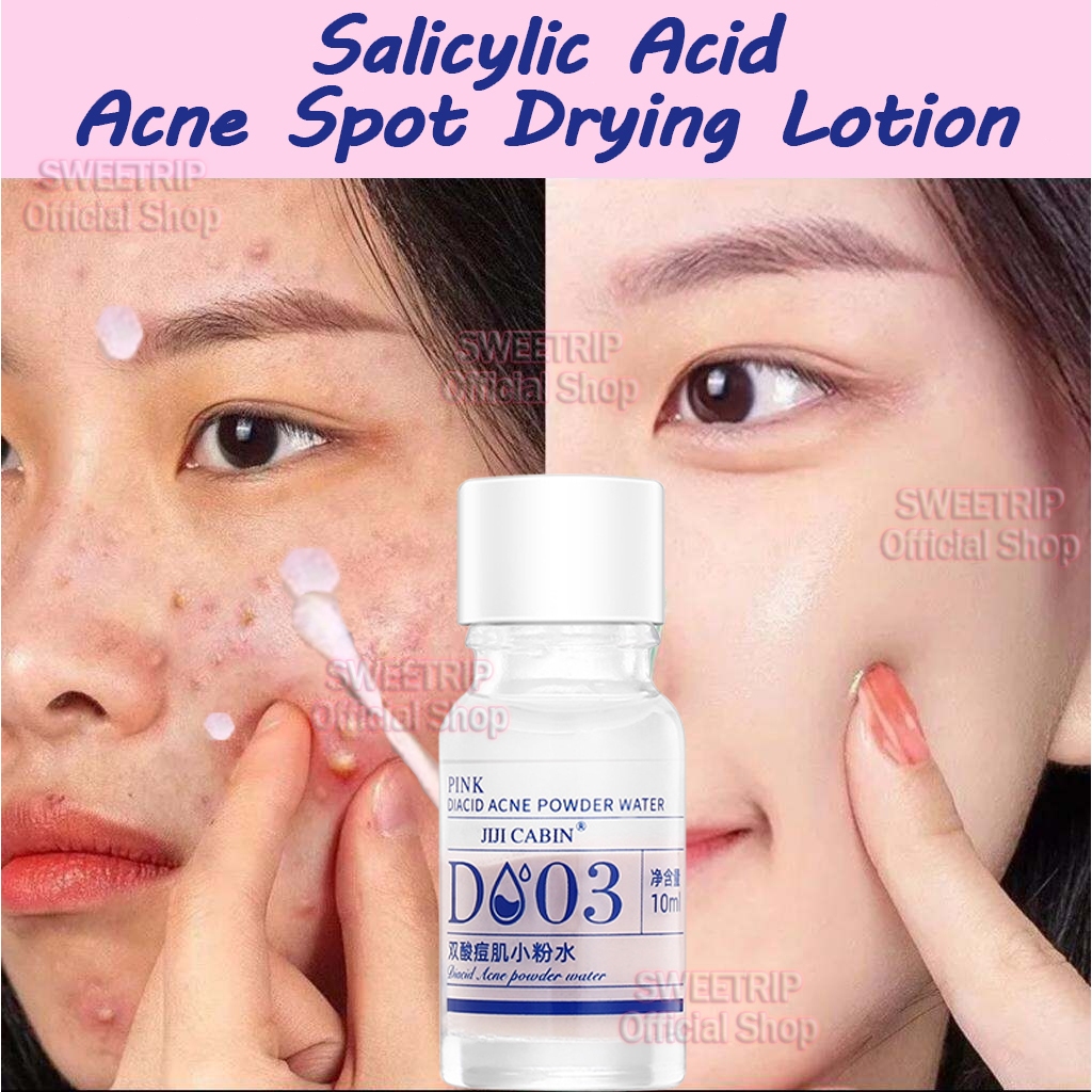 Acne Spot Drying Lotion Salicylic Acid Acne Treatment Powder Water Serum Jerawat Instant Obat Totol 