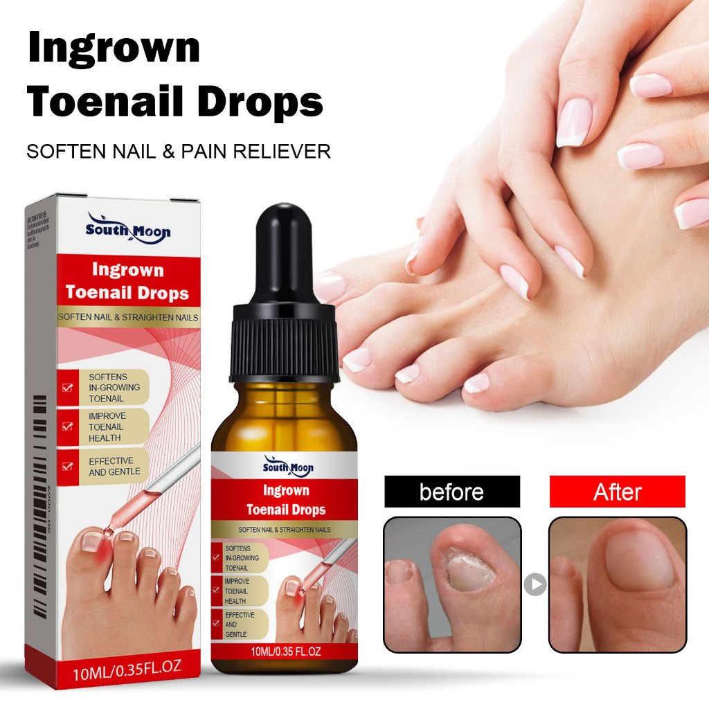 South Moon Ingrown Toenail Drops Nail Treatment Essence Obat Jamur Kuku Obat Kuku Busuk Dan Hitam Ob