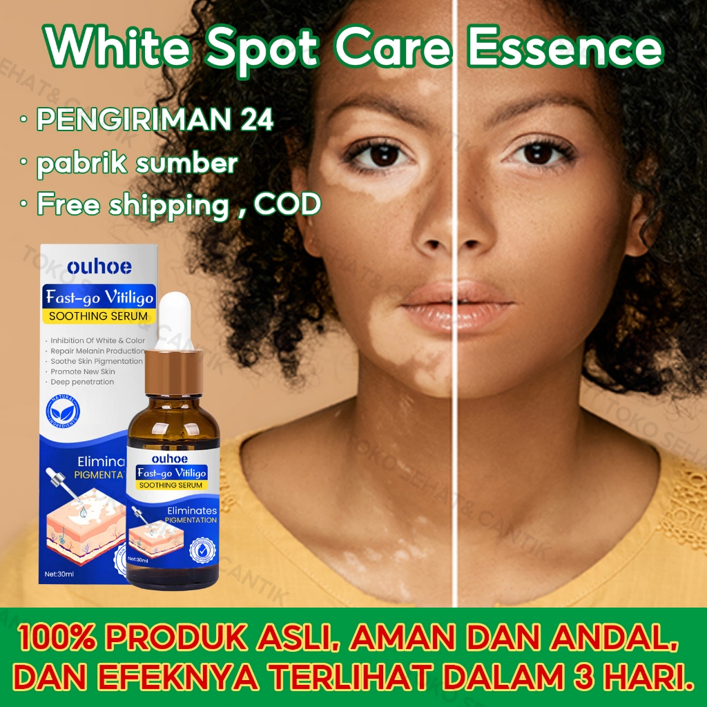 OUHOE Vitiligo Repair Serum 30ml Obat Vitiligo Salep Vitiligo  Salep Salep Vitiligo Ori 100% Vitilig