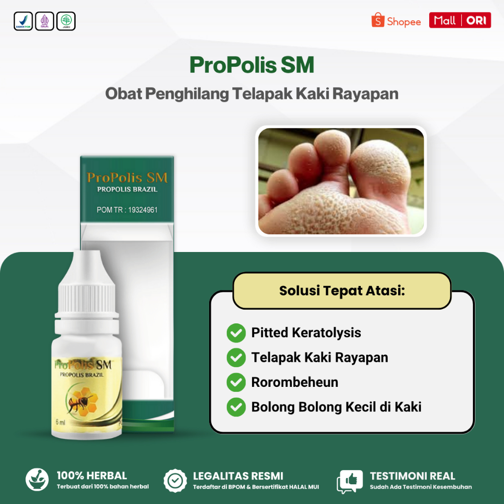 Obat Telapak Kaki Rayapan Pitted Keratolysis, Penghilang Telapak Kaki Rayapan Oles, Propolis SM