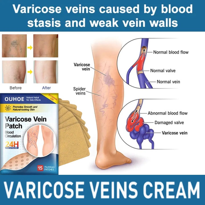 OUHOE 15pcs Koyo Varises Penghilang Varises Di Kaki Varicose Patch Obat Varises Herbal Koyo Varicose