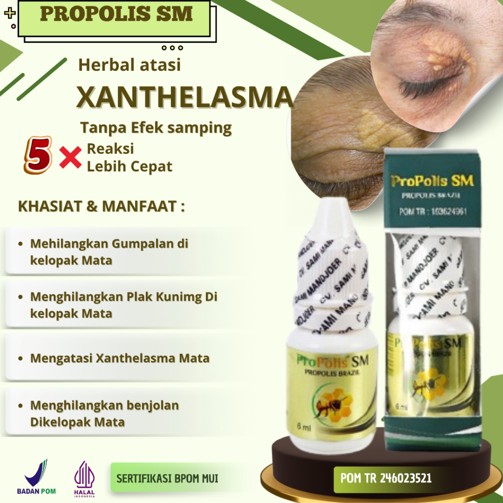 Obat Herbal Cair Penghilang Xanthelasma Syringoma Gumpalan Lemak di Kelopak Mata Kutil Kalazoin