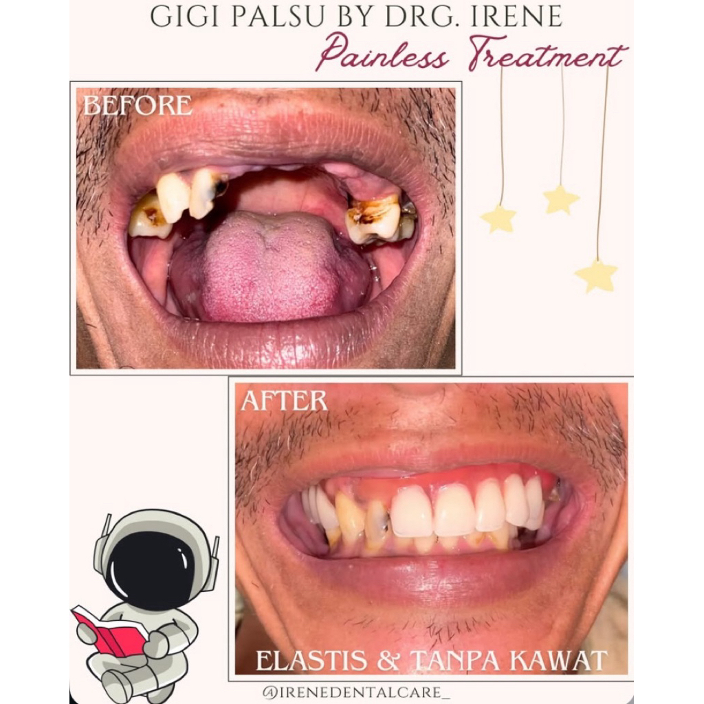 Gigi Palsu 1 Rahang (HANYA GUSI)