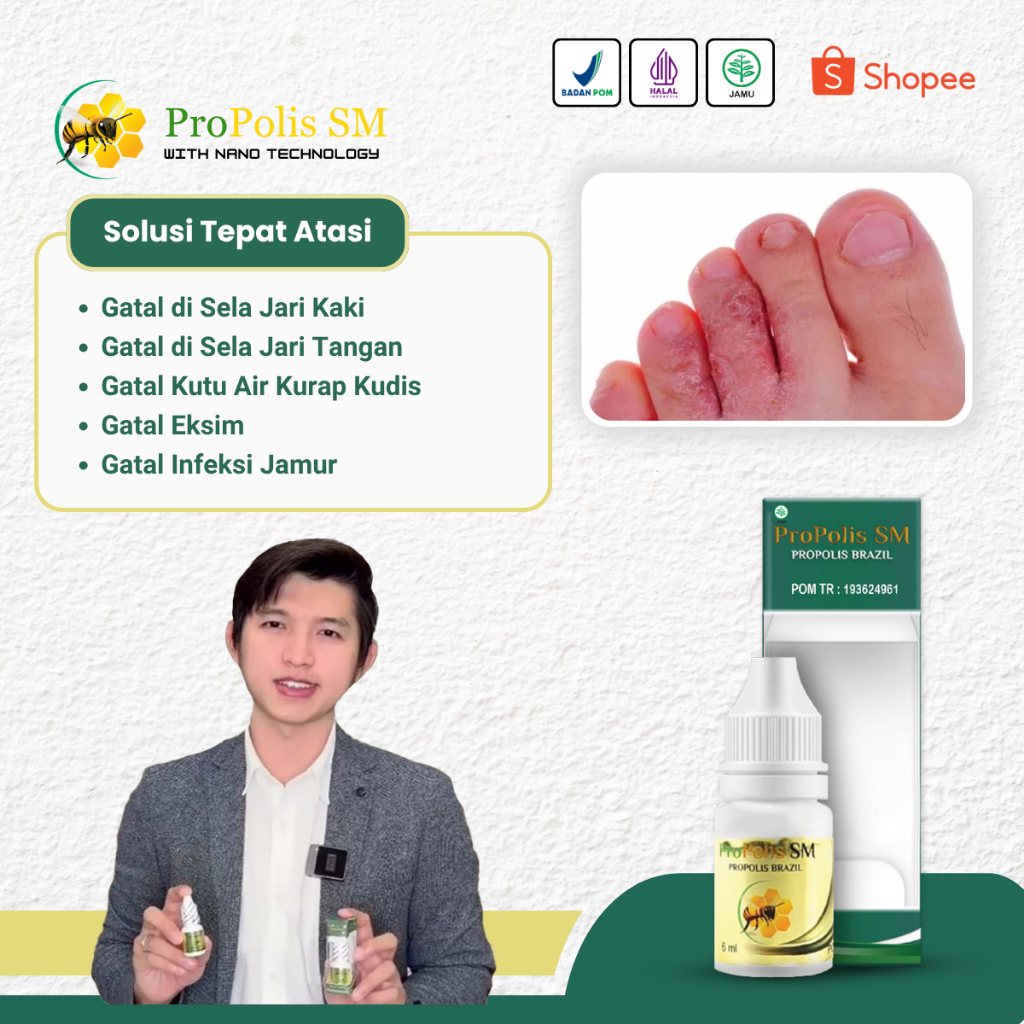 Obat Gatal Berair di Jari Tangan dan Kaki Gatal Kutu Air Kurap Kudis Infeksi Jamur Propolis SM 6ml