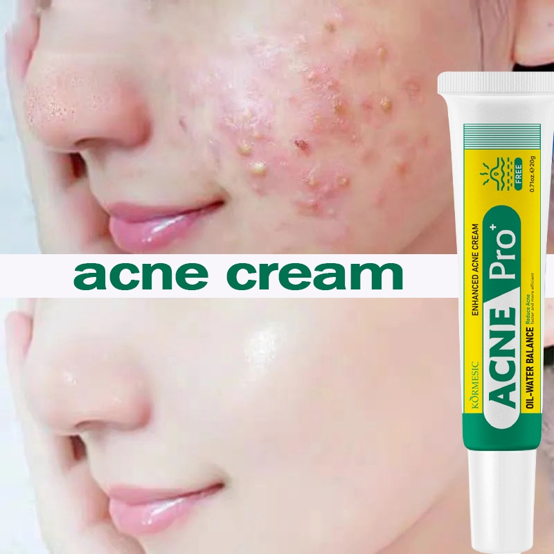 Acne Cream BPOM 20g Penghilang Jerawat Bekas Obat Herbal Salep Bekas Jerawat Acne Spot Treatment Ant