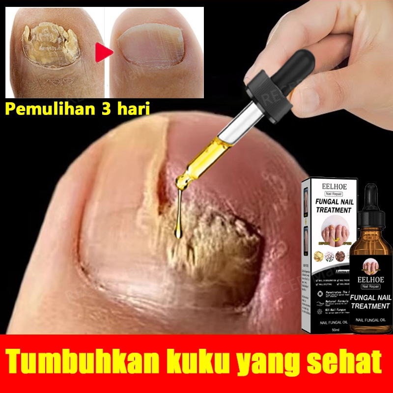 Obat Jamur Kuku obat kuku jamur dan rusak jamur kuku kaki obat kuku obat kuku berjamur obat cantenga