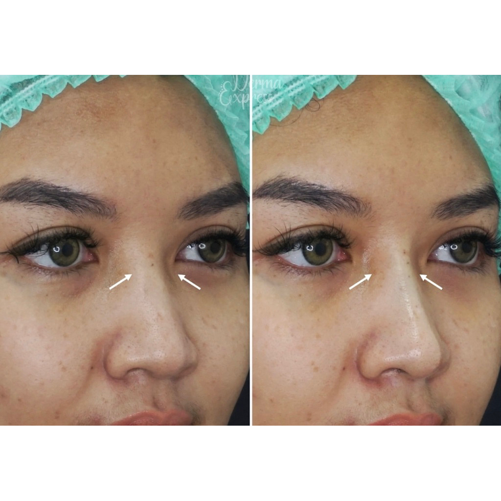 Threadlift hidung paket 4 benang