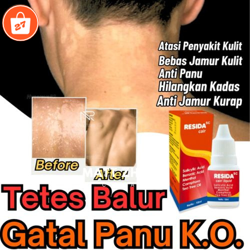 Resida Cair Obat Gatal Kurap Kudis Panu Ampuh 100% /Salep Obat Gatal kurap Kudis Panu Kutu Air Ampuh