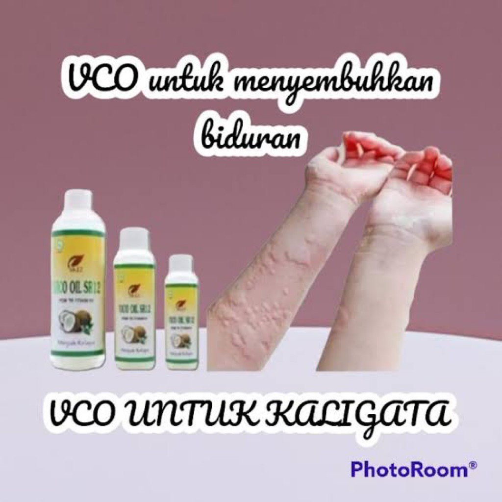 VCO SR12 MINYAK KELAPA AMPUH UNTUK BIDURAN DAN GATAL GATAL