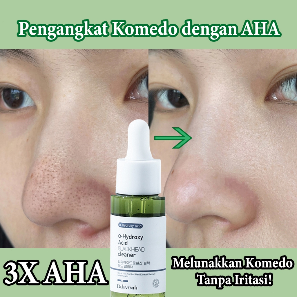 [Spesial Buka Puasa & Stok Hampir Habis]CHICOS Esensi Asam, Essence Pembersih Komedo, Membantu Angka