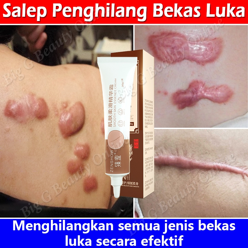 Salep Penghilang Bekas Luka Hitam Koreng Obat Penghilang Bekas Luka Di Wajah Menghilangkan Bekas Luk