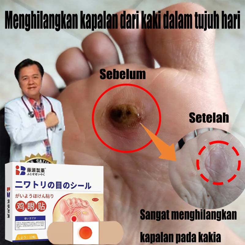 Plester mata ikan Obat mata ikan di kaki Callus remover Obat kaki kapalan Salep mata ikan Callusol m