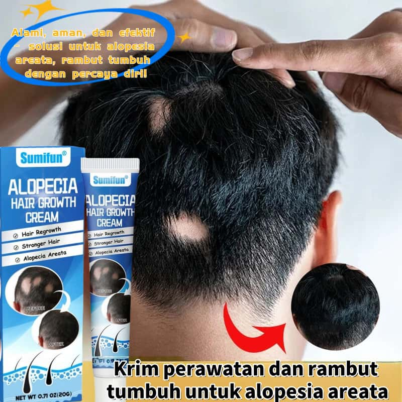 Obat Alopecia Areata 20g Penyubur Rambut Pencegah Rambut Rontok Kerontokan Rambut Pada Pria Dan Wani