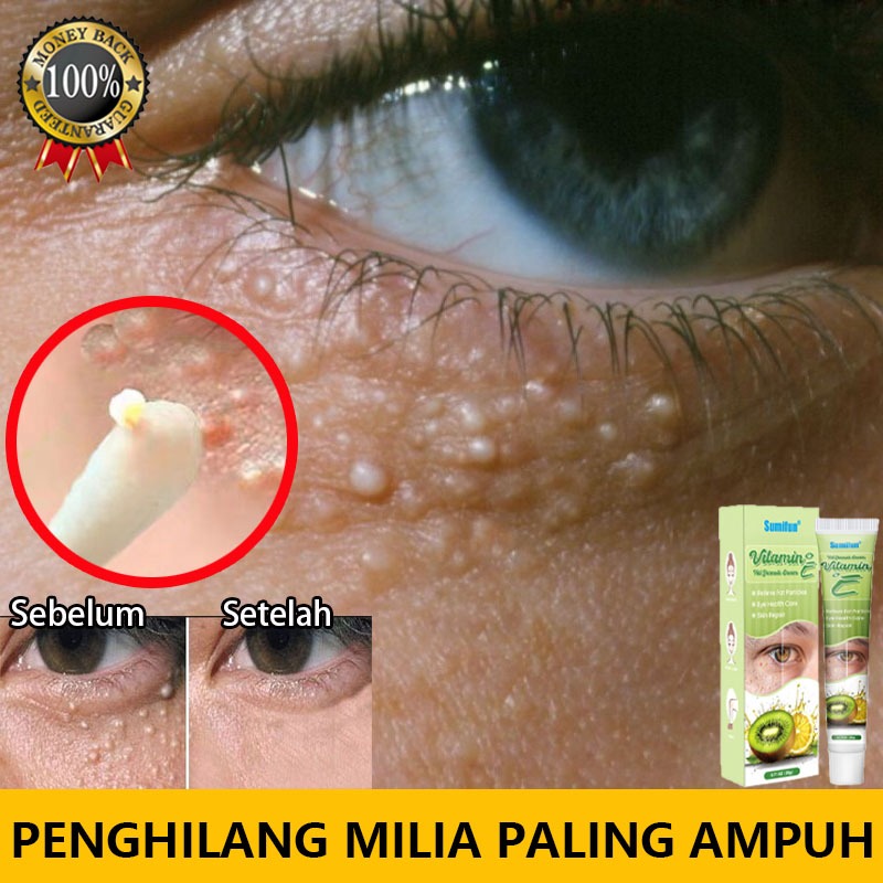 krim penghilang milia Obat milia  Penghilang milia paling ampuh Penghilang milia Milia di bawah mata