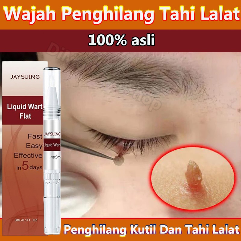 ⚡Original⚡ Penghilang Kutil Dan Tahi Lalat Penghilang Tahi Lalat Di Wajah Penghilang Tahi Lalat Tahi