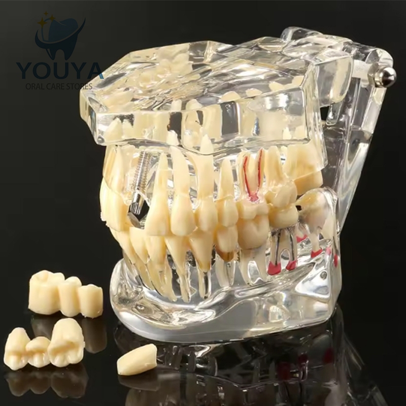 Model study gigi edukasi transparan studi implant phantom crown karies bridge bening impaksi model g