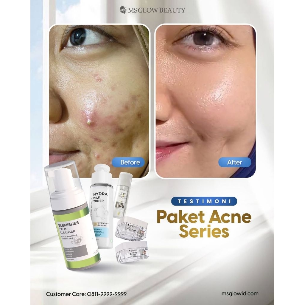 Paket Acne bonus essence  Ms Glow // Garansi Produk Ori