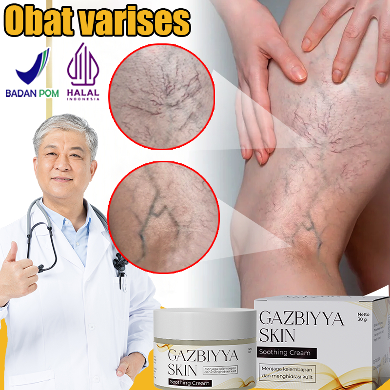 Ecliptor Obat varises kaki Salep varises paling ampuh Obat varikokel 30g obat varises original obat 