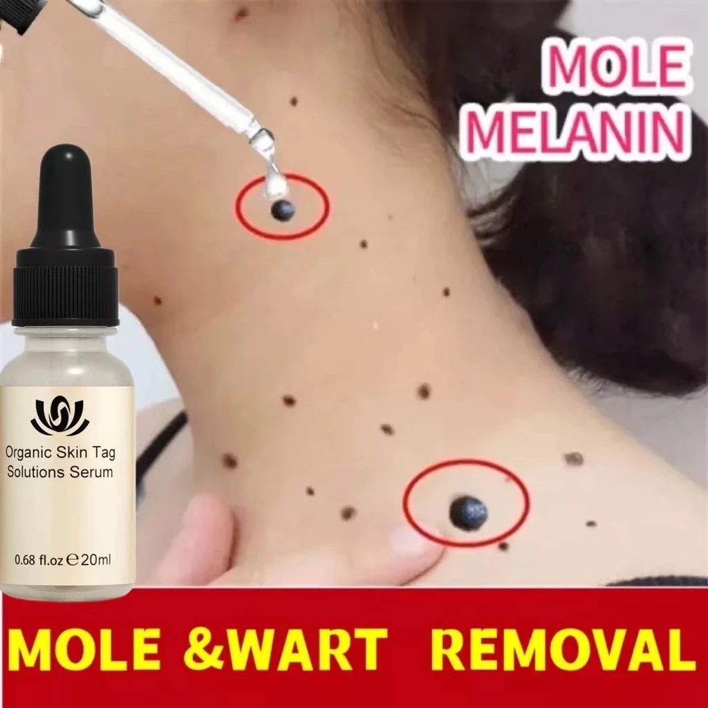 Wart Removal Serum Skin tag remover Penghilang tahi lalat Penghilang kutil dan tahi lalat Penghilang