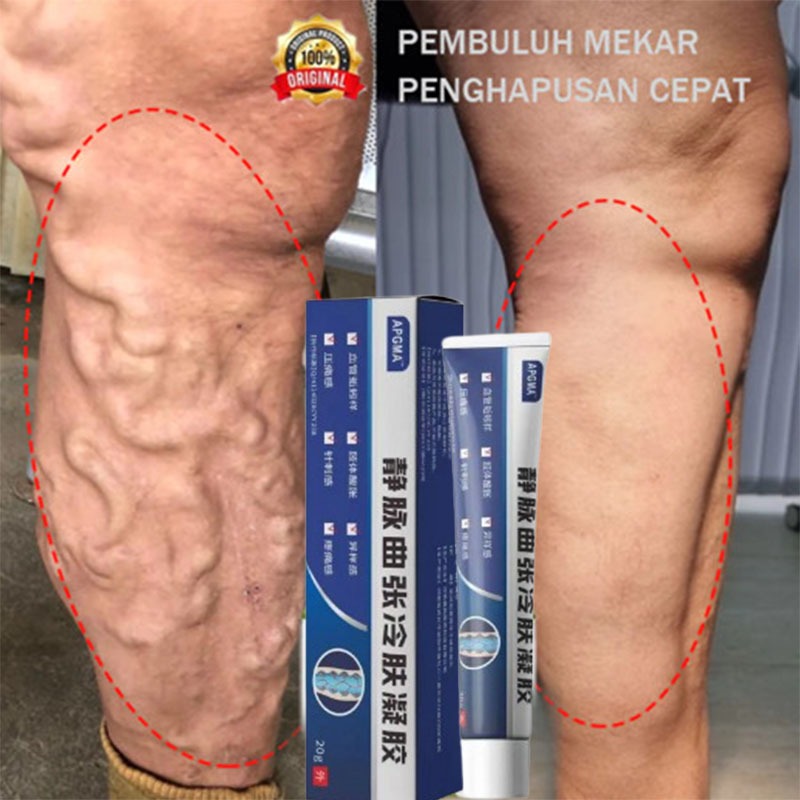 Obat varises di kaki dan betis paling ampuh Obat varises Salep varises obat varises original obat va