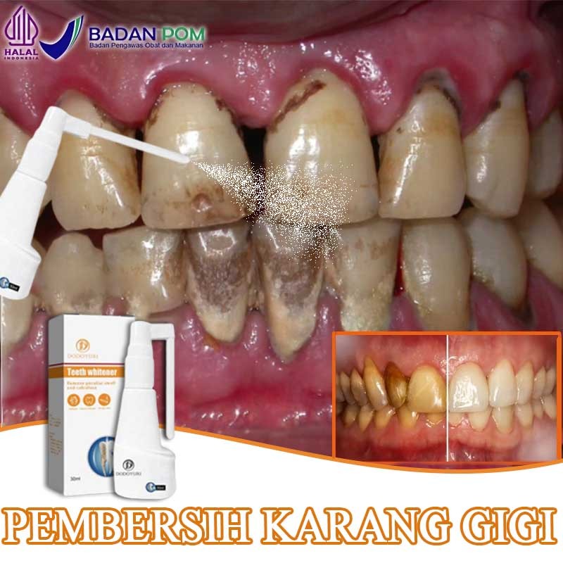 Pembersih gigi kuning dan karang perontok karang gigi dan plak penghilang karang gigi membandel 30ml