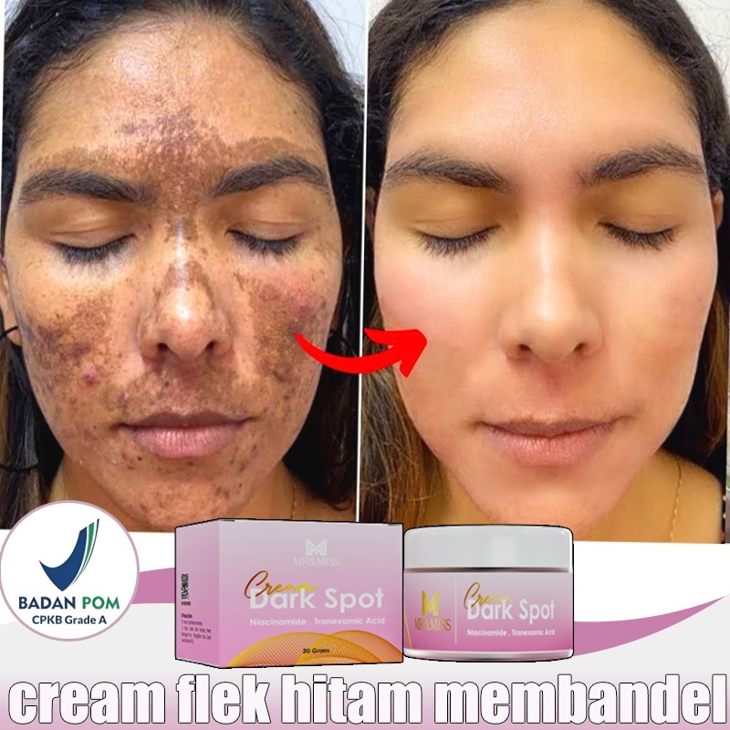 Cream flek hitam membandel Menghilangkan flek hitam di wajah Penghilang flek hitam di wajah Salep fl