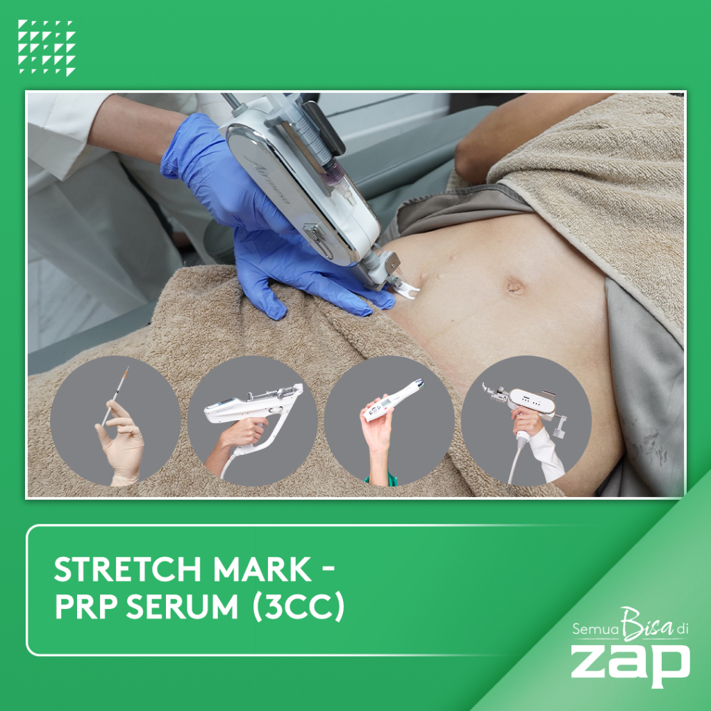 Stretch Mark - PRP Serum (3cc)
