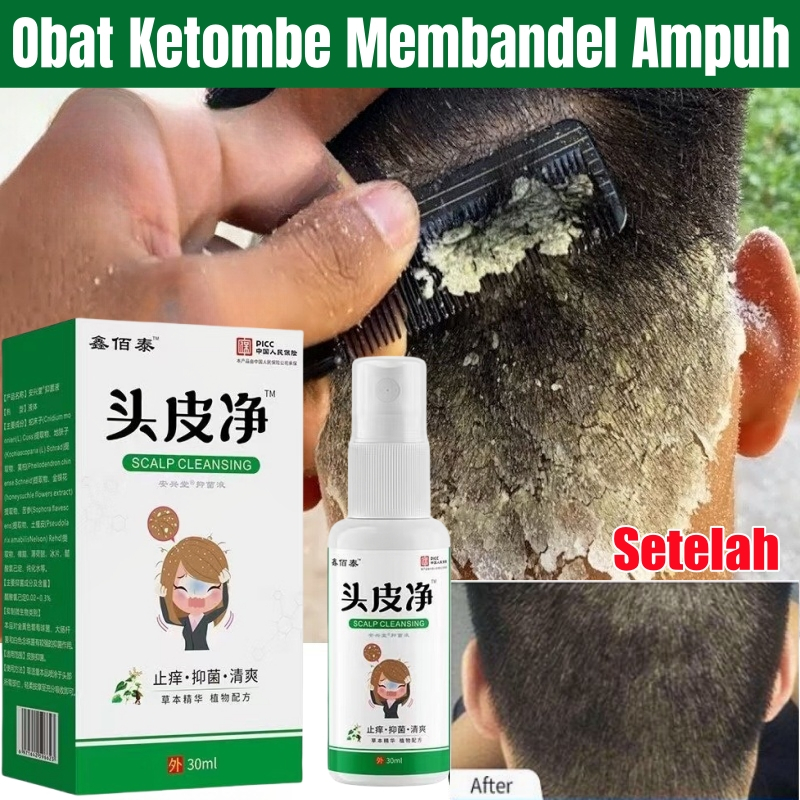 100% ASLIObat Ketombe Paling Ampuh Obat Ketombe Membandel dan Gatal Kulit Kepala Permanen Hilang