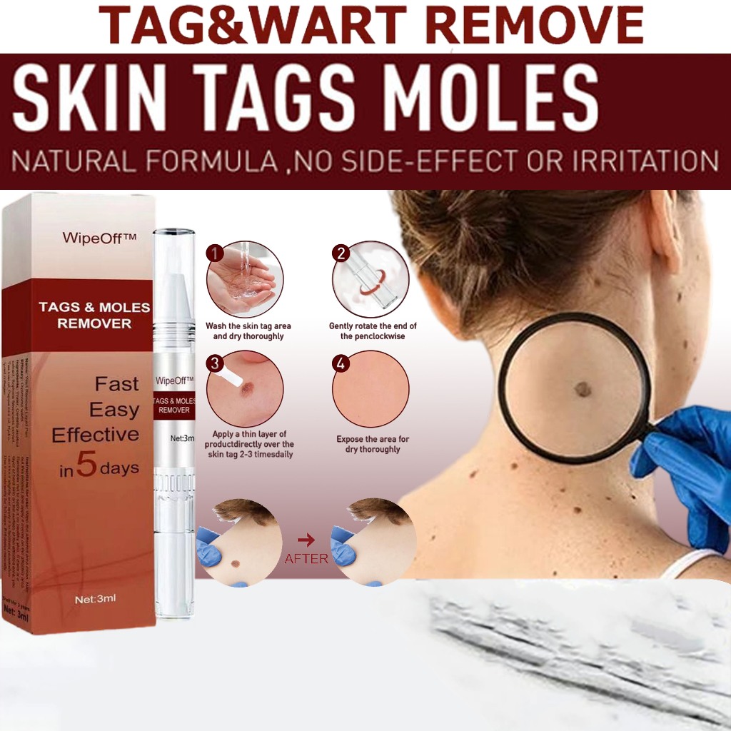 Obat Kutil Paling Ampuh Penghilang Kutil Obat Kutil Kelamin Obat Kutil Di Leher Wipeoff Penghilang K