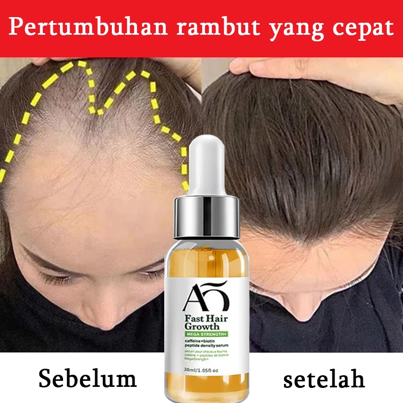 [Pertumbuhan rambut cepat] Obat penumbuh rambut cepat saripati penumbuh rambut kebotakan penumbuh ra