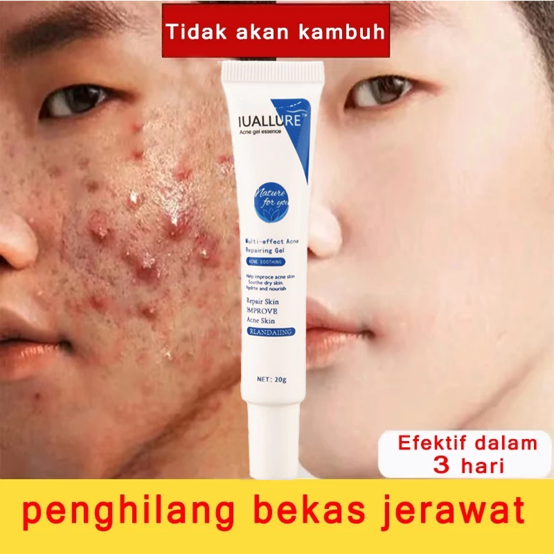 IUALLURE Acne Cream salep Jerawat dan bekas Removal cream  Obat jerawat Gel Bekas jerawat Lotion Acn