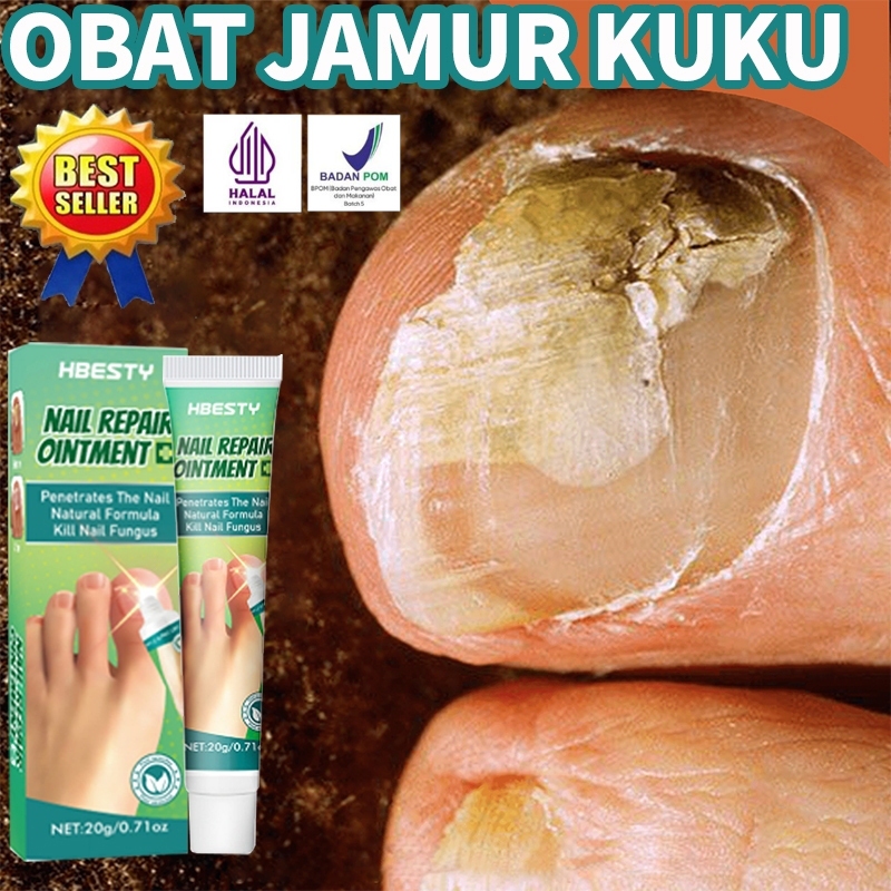✨Garansi Asli✨Obat jamur kuku Obat kuku jamur dan rusak Salep jamur kuku 20g 100% Cairan penekan bak