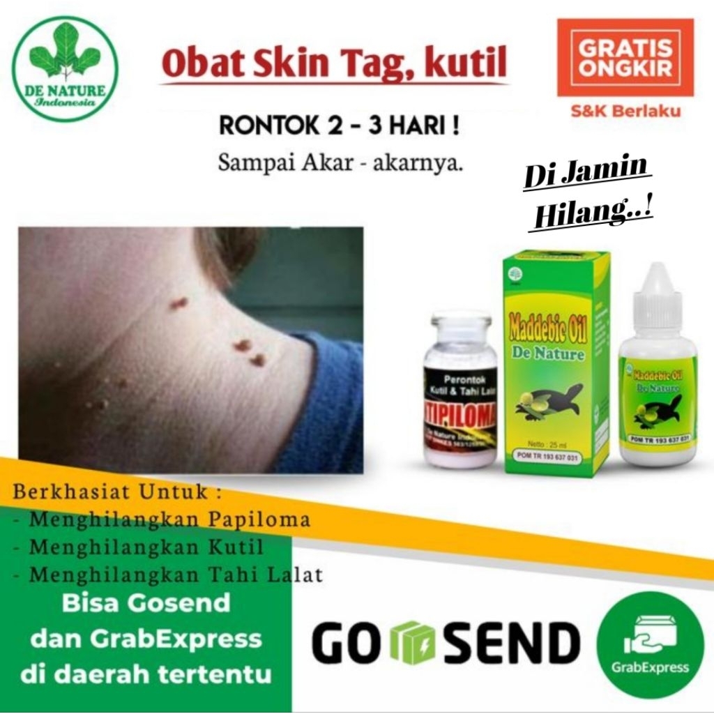 Obat Skin Tag, Penghilang Daging tumbuh di Leher, Wajah, Kelamin, Muka, Papiloma, Kondiloma, Kutil d