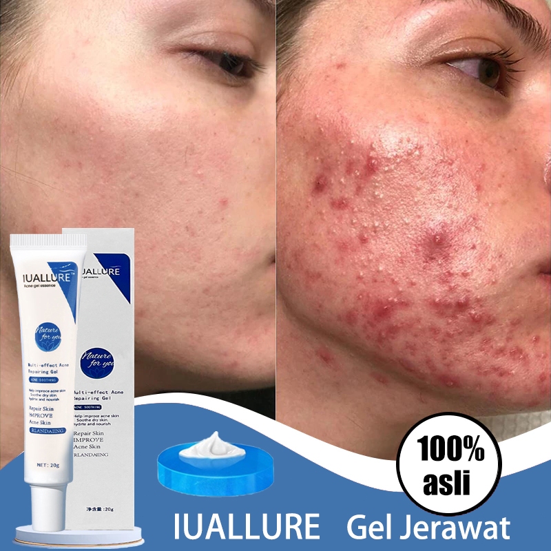 IUALLURE Gel Jerawat | Krim Jerawat | 20g | Menghilangkan jerawat&Meredam bekas jerawat&Memulihkan k