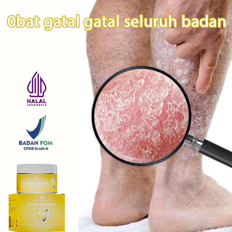 Obat gatal selangkangan dan hitam salap gatal china salep kulit salep eksim kering dan gatal 20g sal